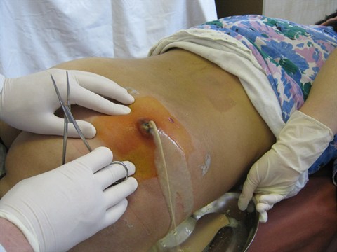 Абсцесс после укола: причины возникновения и способы его лечения